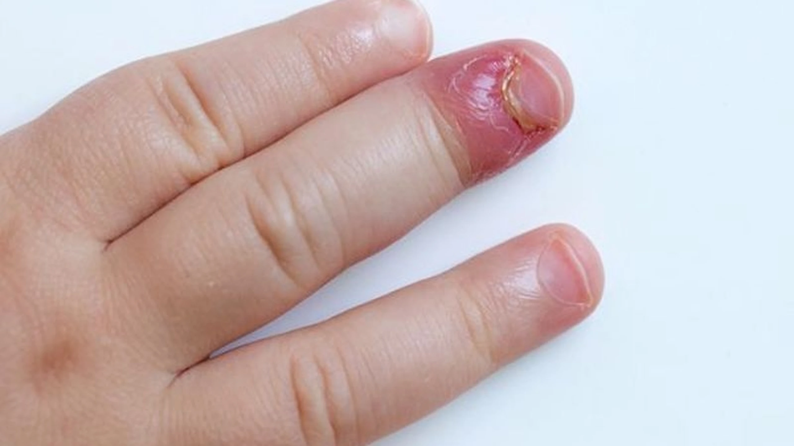 Móng tay bị viêm nhiễm