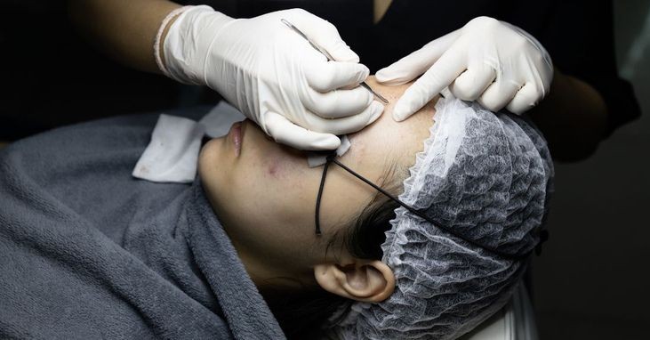 điều trị mụn tại juna spa